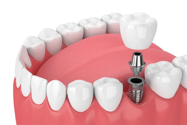 Fixed Teeth by Implants