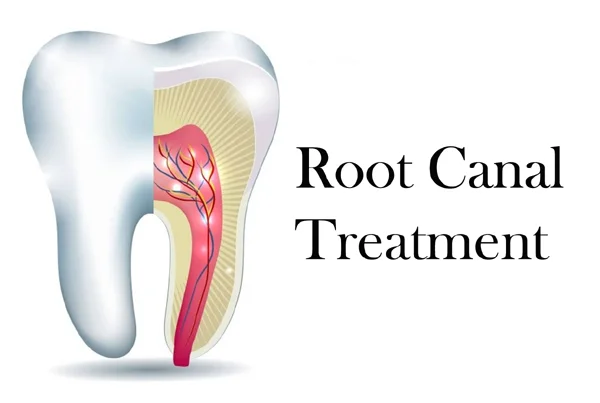 Root Canal Treatment