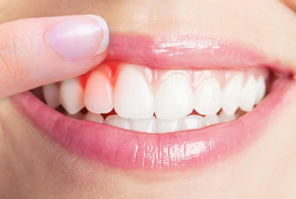 Gums Treatment