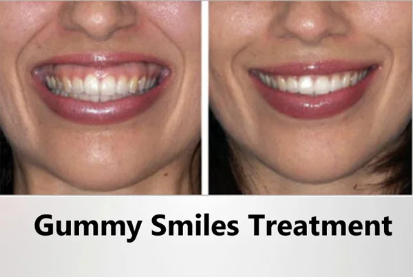 Gummy Smile Treatment