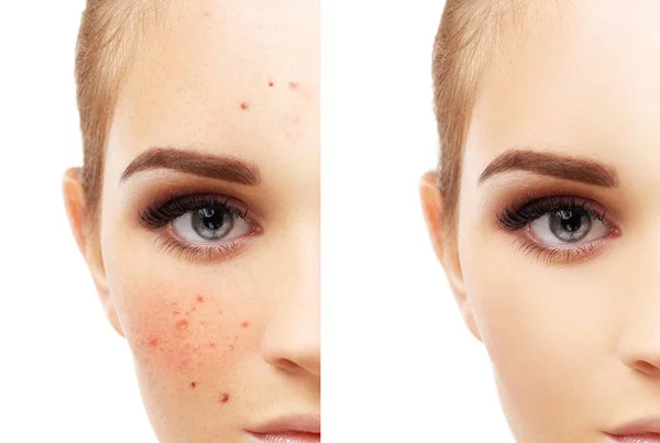 Micro Pigmentation