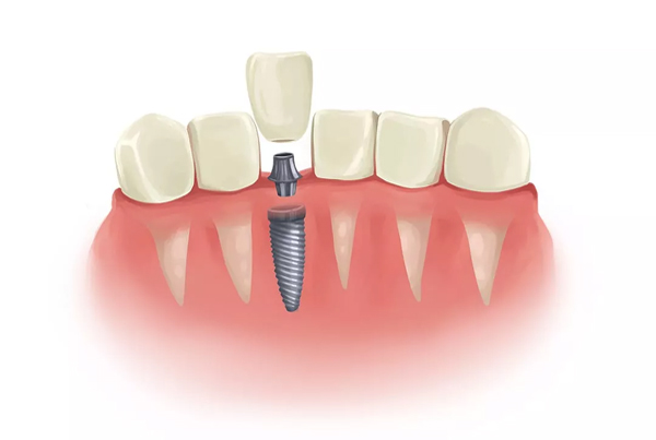 Immediate Dental Implant