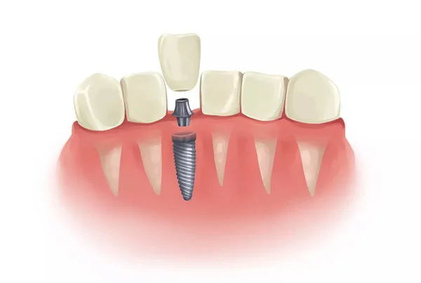 Immediate Dental Implant