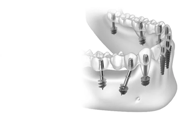 Basal Implant