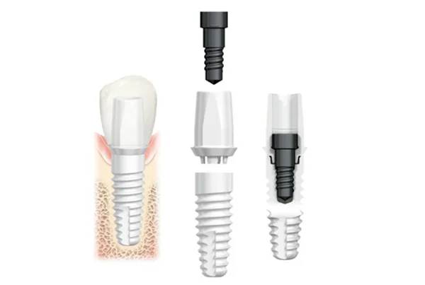 Conventional Implant