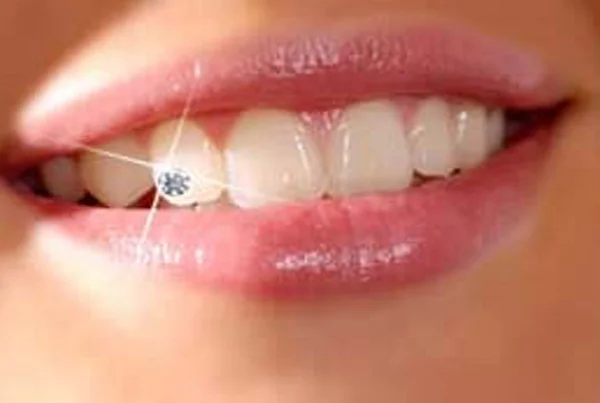Dental Jewellery