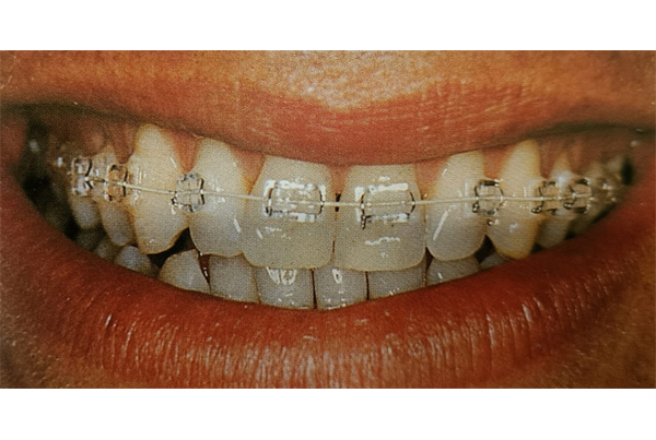 Braces for Misaligned Teeth
