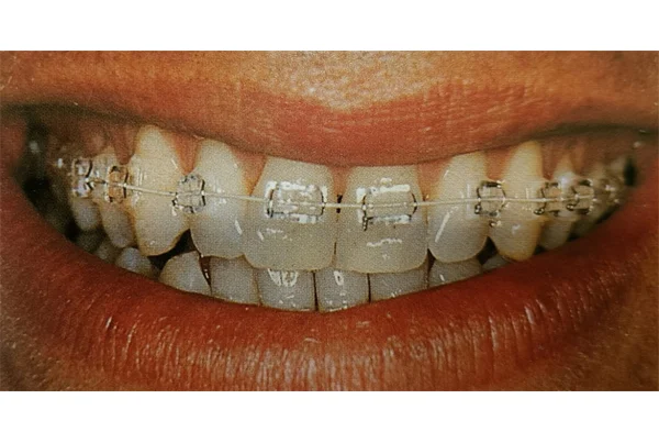 Braces for Misaligned Teeth